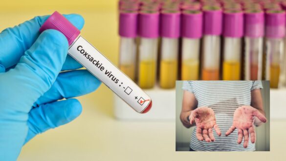 coxsackie